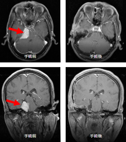 頭蓋底髄膜腫の一例