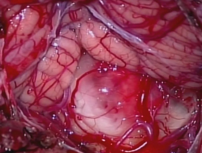 脳幹部腫瘍の開頭手術　　　　　　　